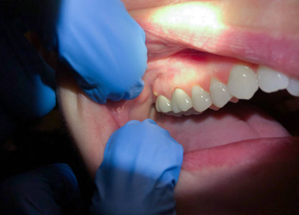 Best Emergency Dental Care for Abscessed Tooth in Vandenberg Village, CA